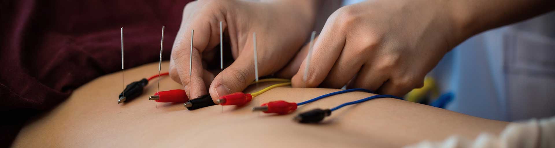 back with Acupuncture needles