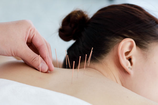 Person receiving acupuncture on their back