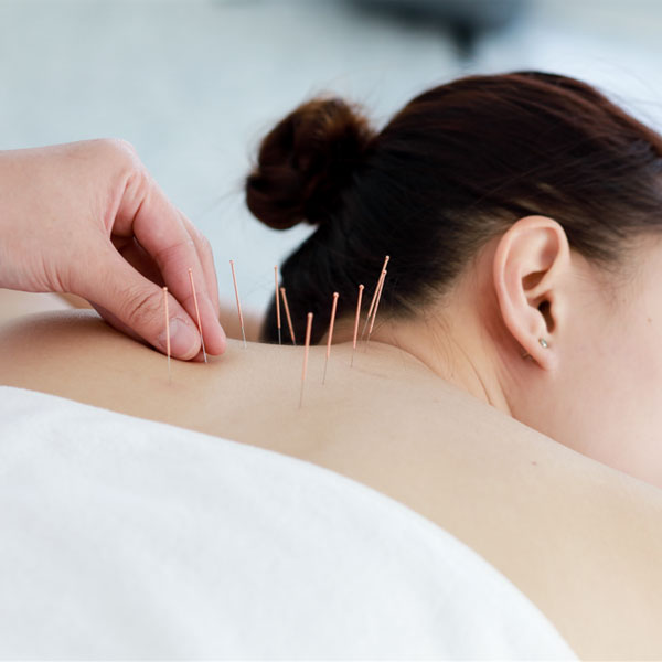 Acupuncture client on table